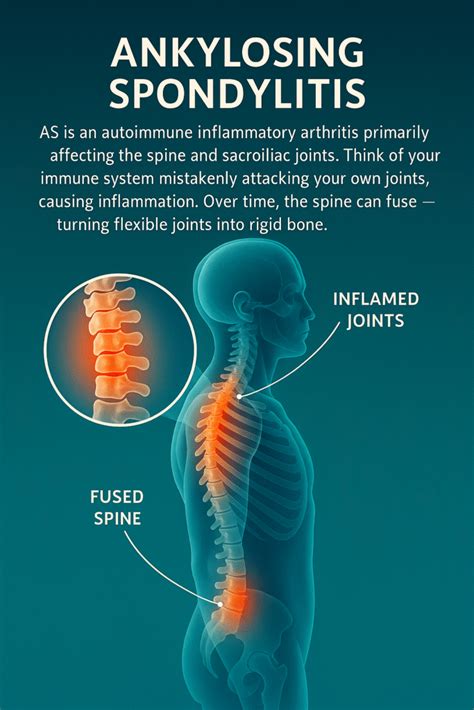 What Really Happens in Ankylosing Spondylitis? Here's Arjun's Journey ...
