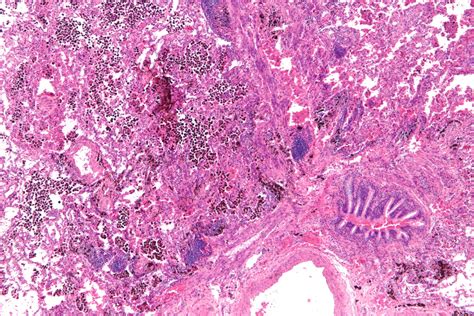 New Model Predicts Diffuse Alveolar Hemorrhage in AAV