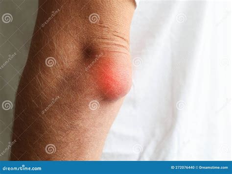 Bursitis, Swelling Elbow from Water Inside Elbow in Man Middle Age. Stock Photo - Image of ...