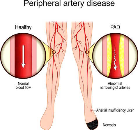 Effective Lifestyle Changes for Peripheral Artery Disease - Showit Blog