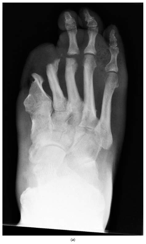 Charcot Foot Xray