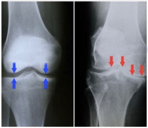 Knee Arthritis In Your 30’s Infection Rheumatoid Trigger - Ventilatsioon
