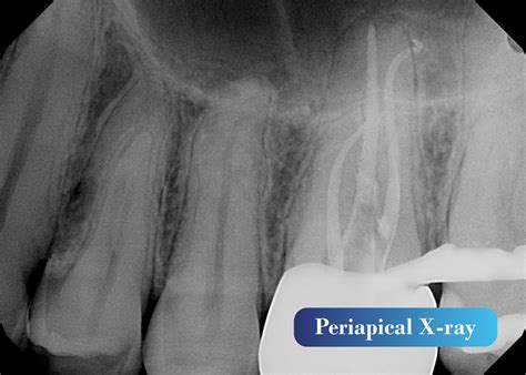 Periapical X Ray