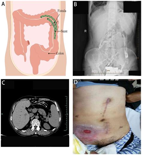 Complex intestinal fistula treated with colon‑indwelling drainage stent ...