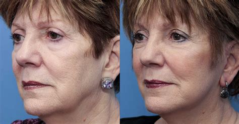 What is a mini-facelift? | Blog | Mount Airy, Maryland Plastic Surgery