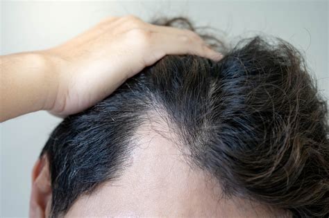 Does Hat Cause Hair Loss? Debunking Common Myths