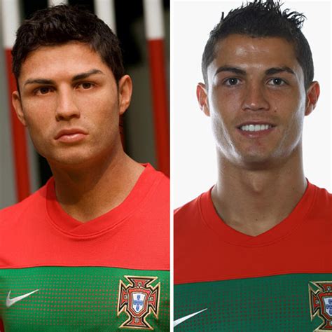 Cristiano Ronaldo Before And After Surgery