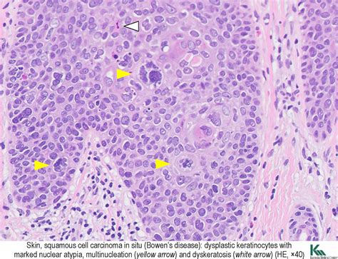 Still's Disease Histology at Natasha Mendis blog