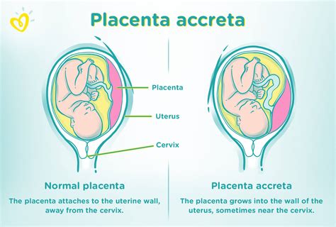 Placenta Accreta: Symptoms, Causes, and Risks | Pampers