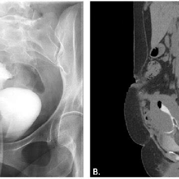 Image result for CT Cystogram vs Urogram