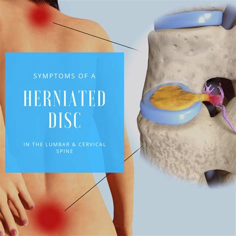 Symptoms Of A Herniated Disc In The Lumbar & Cervical Spine | New Jersey | Comprehensive Spine Care