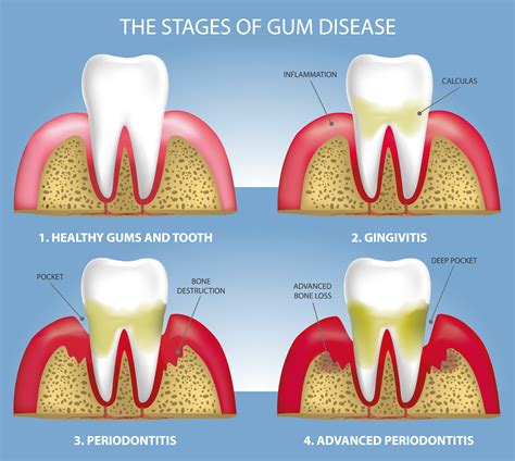 Mild Periodontitis Treatment