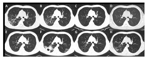 Vasculitis Secondary to Pulmonary Bacterial Infection: A Case Report