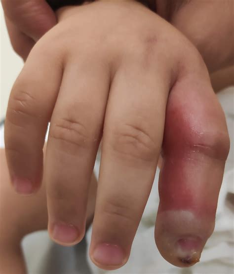 An unexpected complication of gingivostomatitis | Pediatric Oncall Journal