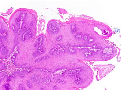 Pathology Outlines - Squamous papilloma