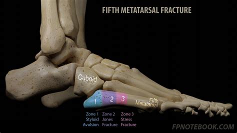 Fifth Metatarsal Fracture