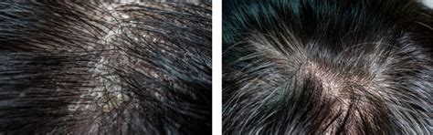 Scalp Psoriasis and Dermatitis 3 Step Care Bundle – Oleum Cottage