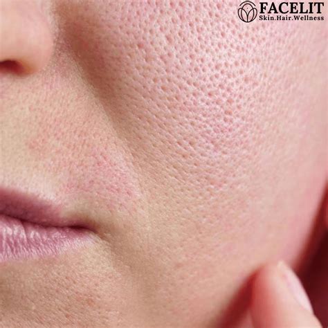 Clogged Pores On Forehead