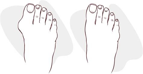 Laser Bunion Removal - Everything to Know | The Bunion Cure
