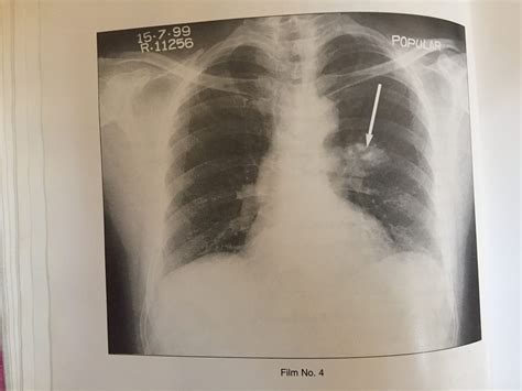 What Does Calcium Deposits In Lungs Mean at Angela Williamson blog