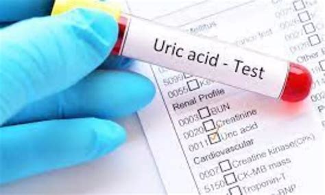 Multiple serum urate testing not superior to single test for gout ...