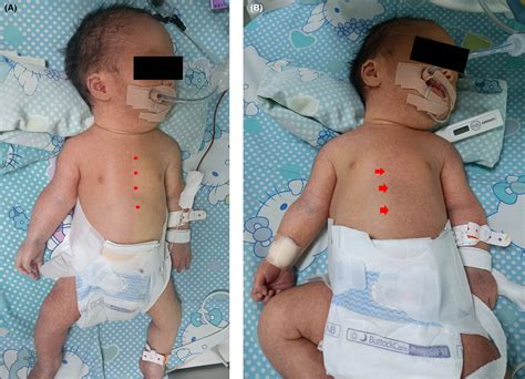 Harlequin Sign Newborn