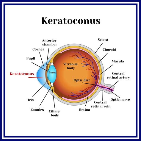 Keratoconus: Causes, symptoms, diagnosis, and treatment.