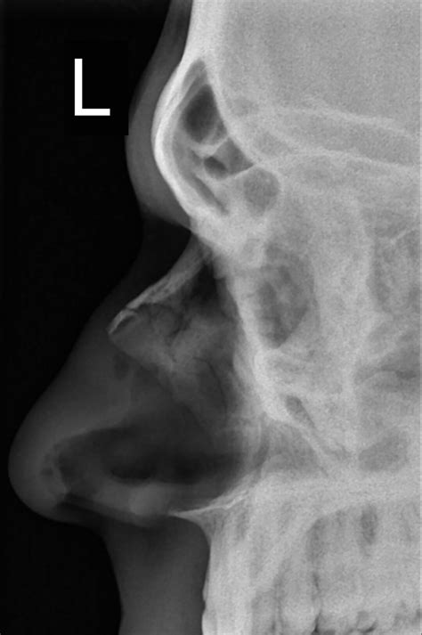 Should You Tape A Broken Nose at Vaughn Josephs blog