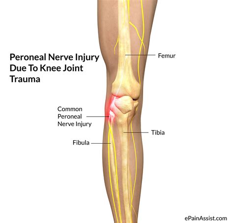 Peroneal Nerve Injury - Treatment, Causes, Symptoms