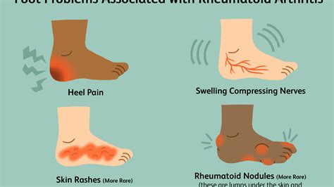 Heel Pain: Causes, Treatment, And When To See A Doctor, 58% OFF