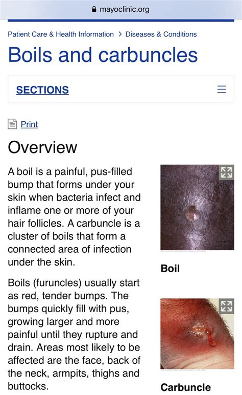 Carbuncle Vs Furuncle