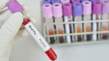 Infectious Diseases : Bird Flu : Bird Flu Patient Education : Diseases ...