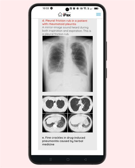 On July 18, the quiz focuses on selecting the pleural friction rub from ...