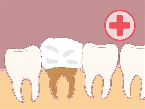 4 Ways to Prevent Dry Socket After a Tooth Extraction - wikiHow