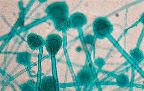 Mykosen der Nasennebenhöhlen - HNO - Universimed - Medizin im Fokus