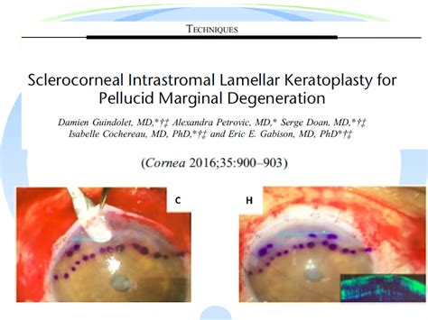 Keratotorus pellucid marginal degeneration | PPT