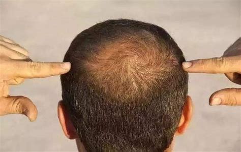 头秃顶怎样才能长头发？（内含方法、建议） - 知乎