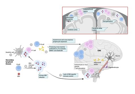 Does EBV trigger multiple sclerosis and drive its progression? - Drug ...