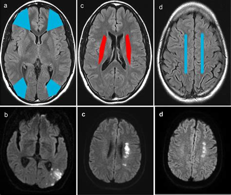 Figure 1 from Relationship between Watershed Infarcts and Recent Intra Plaque Haemorrhage in ...