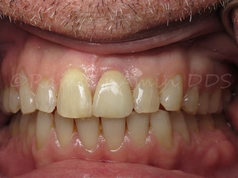 Center Front Dental Implant -Ramsey Amin DDS | Ramsey A. Amin, DDS