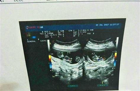 你好：这是我怀孕的B超单，我想确定有囊肿可以顺产么 - 百度宝宝知道