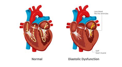 Image result for Moderate Diastolic Dysfunction