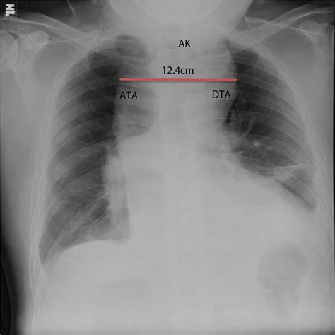 A Rare Case of an Ascending Aorta and Aortic Arch Aneurysm with an ...