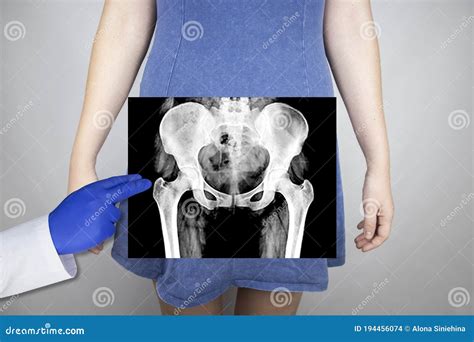 Young Female Pelvis X Ray Normal