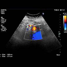 vasi addominali ecografia ed ecocolordoppler protos vasi addominali ecografia ed ecocolordoppler protos