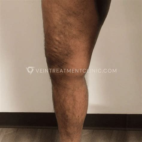 Can Varicose Veins Go Away on Their Own? | What to Expect | Vein Treatment Clinic