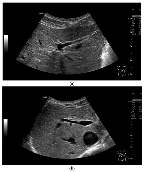 Ultrasound of Bile Ducts—An Update on Measurements, Reference Values, and Their Influencing Factors