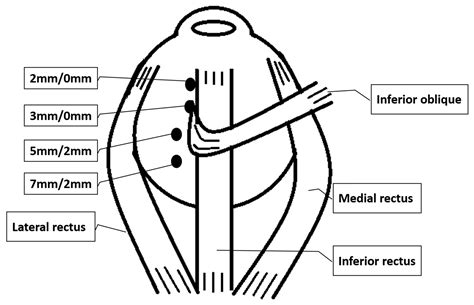 Inferior Oblique Palsy