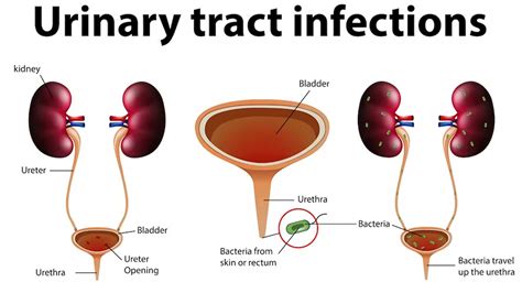 Does UTI Cause Stomach Pain? – NutritionFact.in