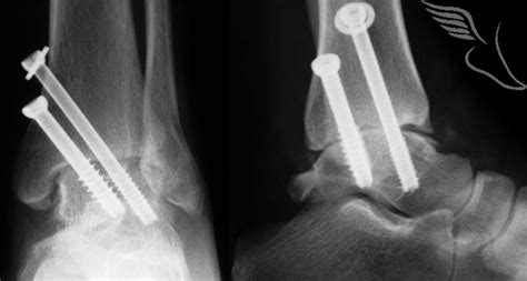 arthroscopic-ankle-fusion-29-1 - The Foot and Ankle Clinic